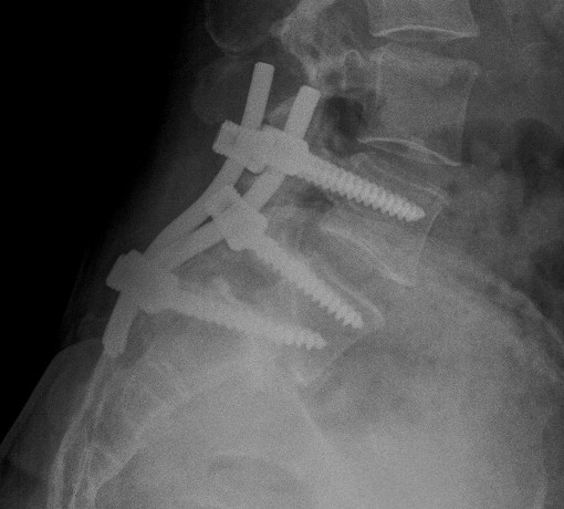 Spondylolithesis Transfixing Screw Lateral